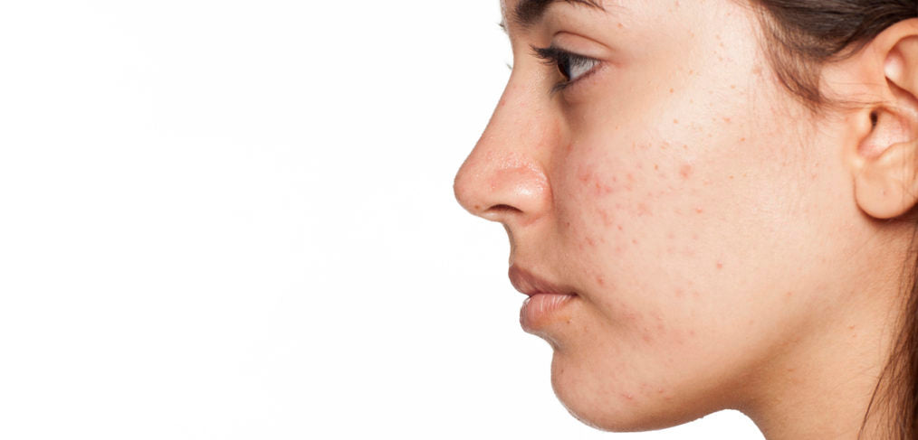 Three Types of Acne, and How to Treat Them