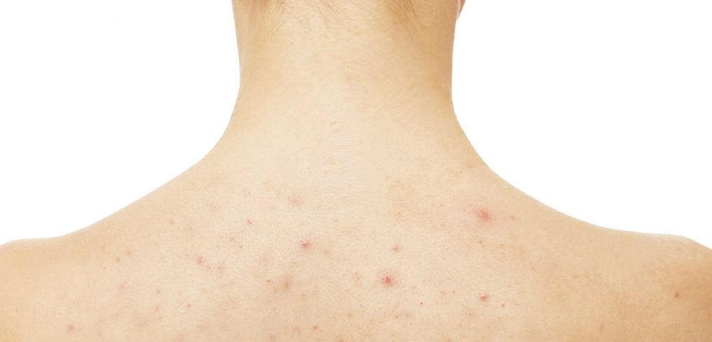 All About Body Acne – How It’s Different Than Face Acne And How To Treat It